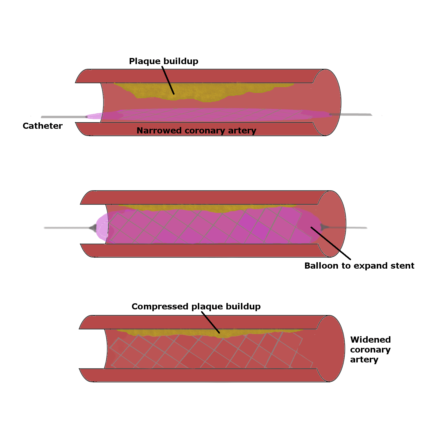 Découvrez le Stent Cardiaque : Un Allié pour Votre Santé Cardiaque 2 stent cardiaque