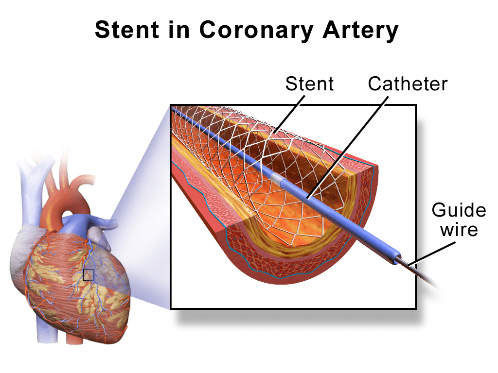 Découvrez le Stent Cardiaque : Un Allié pour Votre Santé Cardiaque 1 stent cardiaque