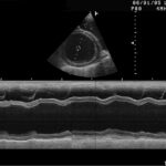 Cardiomyopathie