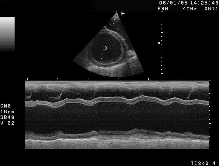 Comprendre la Cardiomyopathie : Causes, Symptômes et Traitements 1 Cardiomyopathie